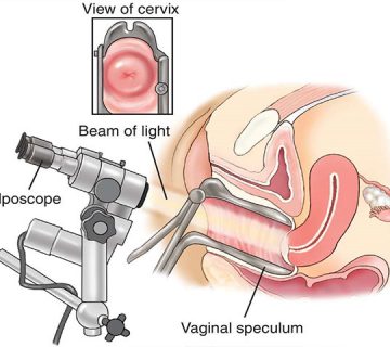 کولپوسکوپی