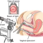 Coloposcopy asiaclinic 150x150