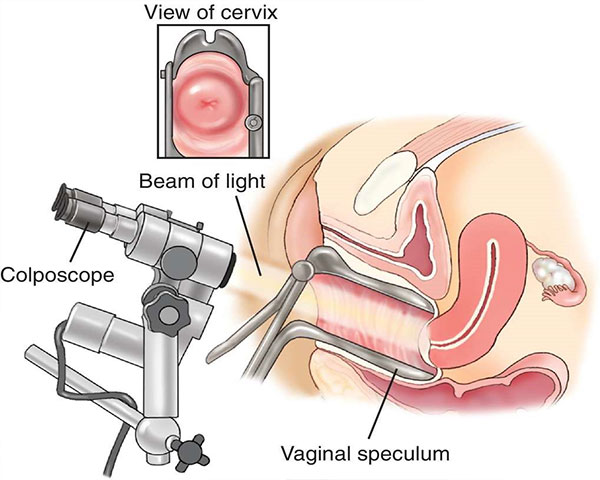 Coloposcopy asiaclinic